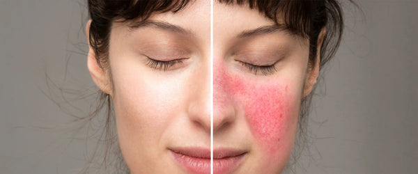 Beyond Blush: Causes of Facial Redness and Effective Cures
