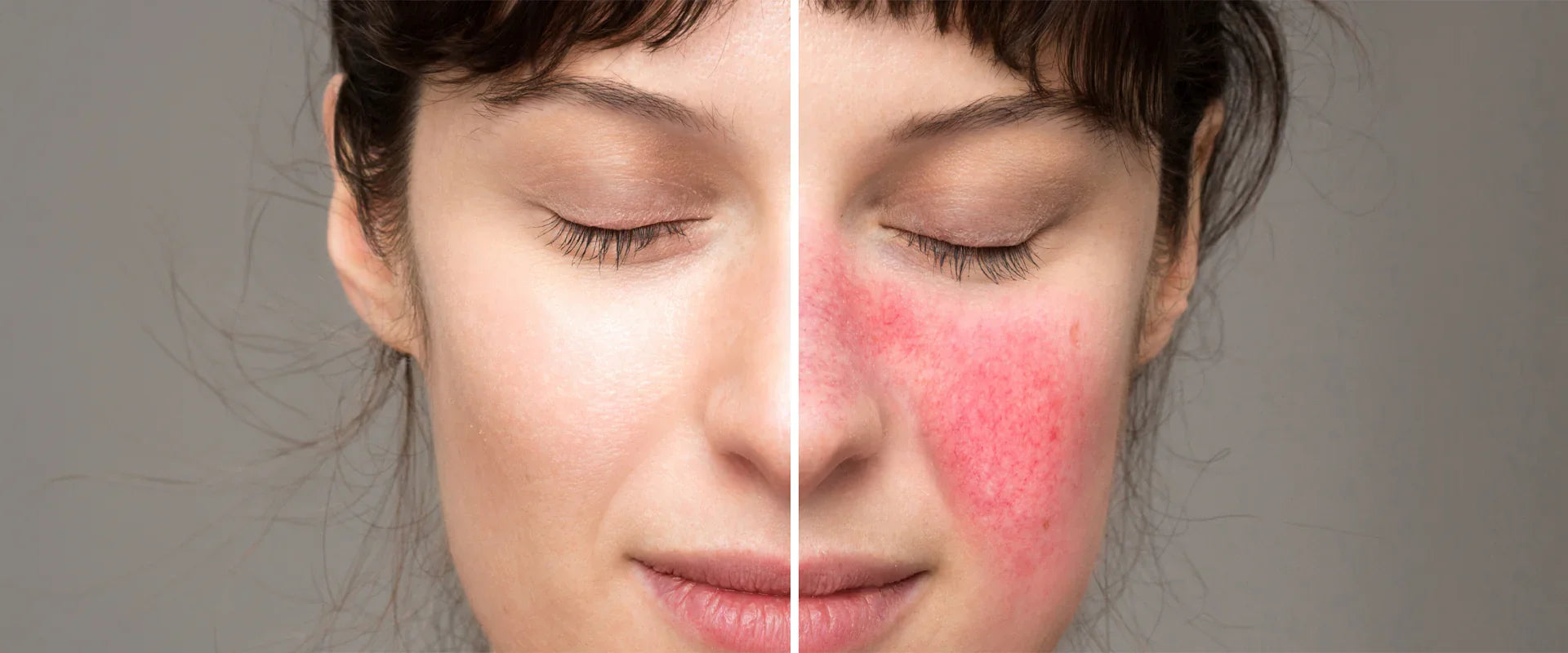 Beyond Blush: Causes of Facial Redness and Effective Cures